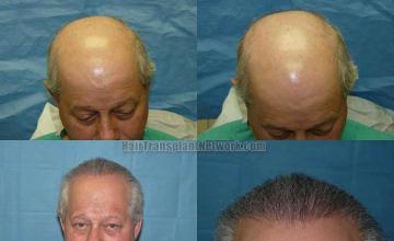 Before and after hair transplantation surgery