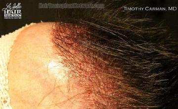 Hair transplantation surgery before and after pictures