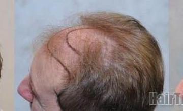 Left - Top angle results from hair replacement procedure