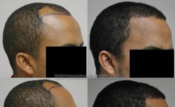 Hair restoration procedure before and after results