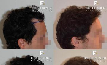 Before and after hair transplantation result photographs