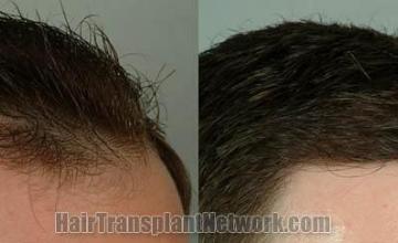 Hair restoration procedure before and after results