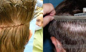 Residual donor scar area from hair restoration procedure