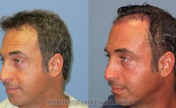 Hair restoration procedure before and after pictures