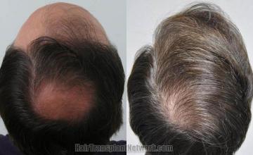 Hair transplantation surgery before and after images