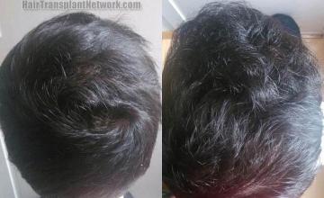 Hair transplantation surgery before and after pictures