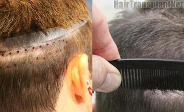 Hair transplantation surgery before and after images