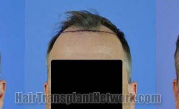 Front view before and after hair replacement procedure