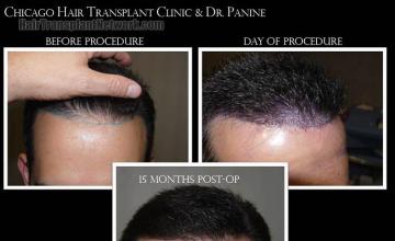 Hair restoration procedure before and after results