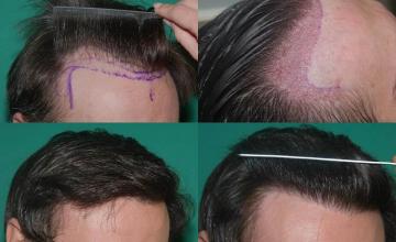 Hair transplantation surgery before and after photos