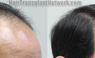 Hair transplantation surgery before and after pictures