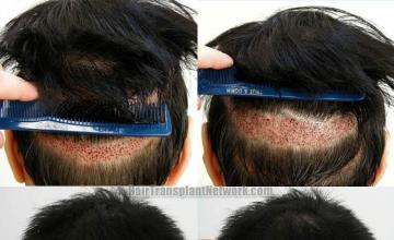 Hair transplant donor scar photos