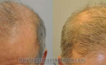 Top view before and after hair restoration results