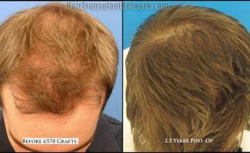 Hair restoration procedure before and after results