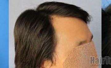 Right side views showing hair restoration results