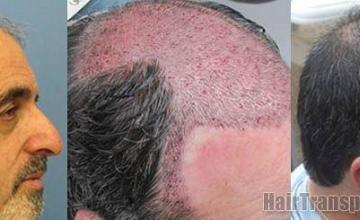 Right side patient results from hair transplant