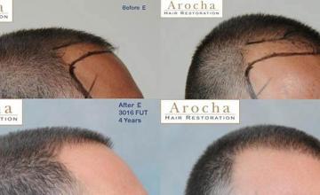 Right view before and after hair transplant repair procedure