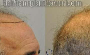 Hair transplantation surgery before and after photos