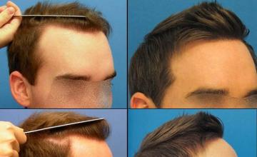 Hair transplantation surgery before and after photos