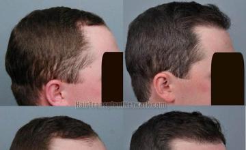 Hair transplantation surgery before and after pictures