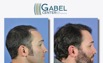 Hair transplantation surgery before and after images