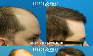 Hair restoration procedure before and after results