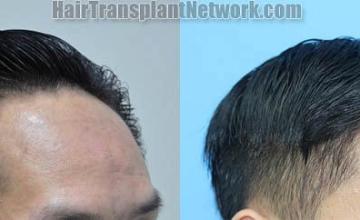 Hair restoration procedure before and after result images