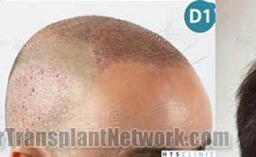 Hair restoration procedure after result images