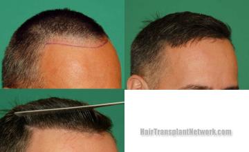 Hair restoration procedure before and after results