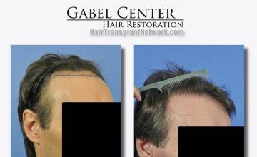 Hair restoration surgery before and after photos