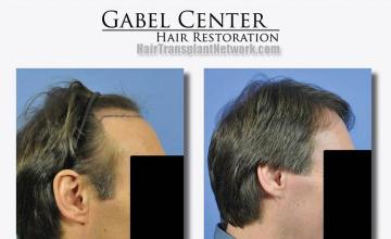 Hair transplantation surgery before and after photos