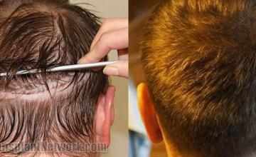 Hair transplantation surgery before and after pictures