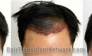 Top view before and after hair transplant procedure