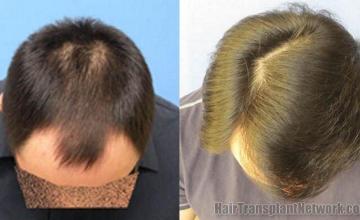 Top view showing hair transplant results from 4298 grafts