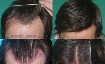 Top view before and after hair restoration results