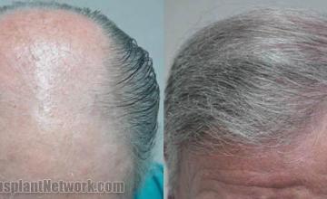 Hair transplantation surgery before and after photos