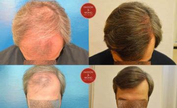 Hair restoration procedure before and after pictures