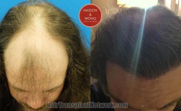 Hair transplantation surgery before and after photos