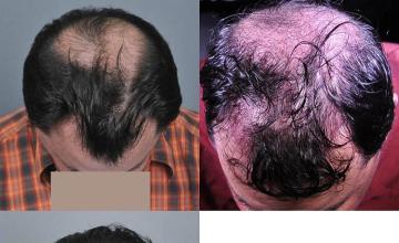 Surgical hair transplantation result photographs