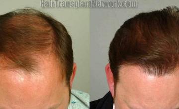 Hair transplantation surgery before and after images