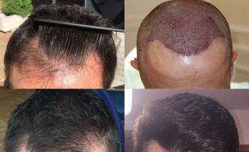 Top view - Before and after hair restoration procedure