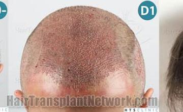 Hair transplantation surgery before and after images