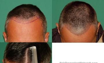 Hair restoration procedure before and after results