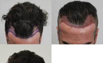 Hair transplantation surgery before and after images