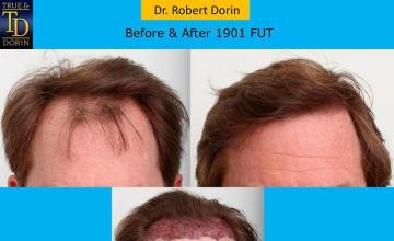 Hair transplantation surgery before and after photos