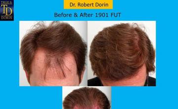 Hair transplantation surgery before and after images