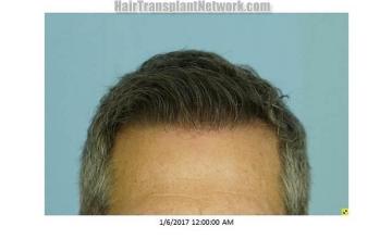 Hair restoration surgery before and after pictures