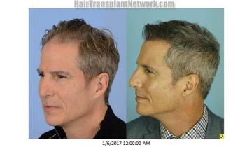 Hair restoration procedure before and after pictures