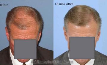 Hair restoration procedure results