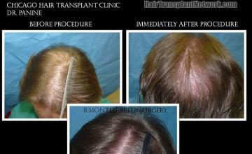 Top view - Before and after surgical hair replacement